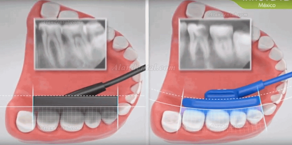 VATECH EZSensor Soft Type Dental X Ray Sensor